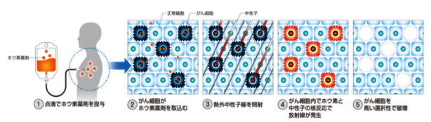 去日本看病，BNCT（硼中子捕捉疗法）原理是什么？治疗有什么特点？